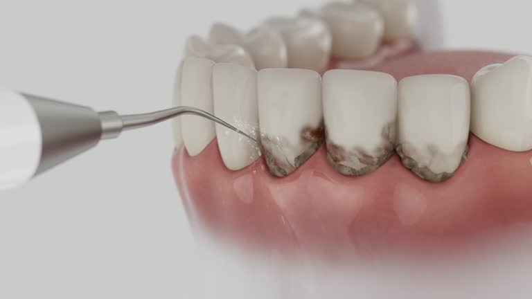 Trusted Dental Crowns And Bridges service in Audubon Park, KY - Dentist Open Now